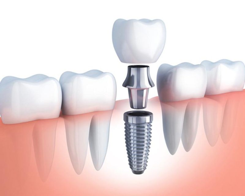 Địa chỉ trồng răng implant uy tín tại đà nẵng